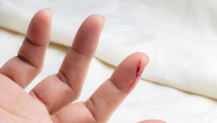 Kağıt Kesiği Nasıl Geçer? Hızlı Müdahale ve Etkili Tedavi Yöntemleri